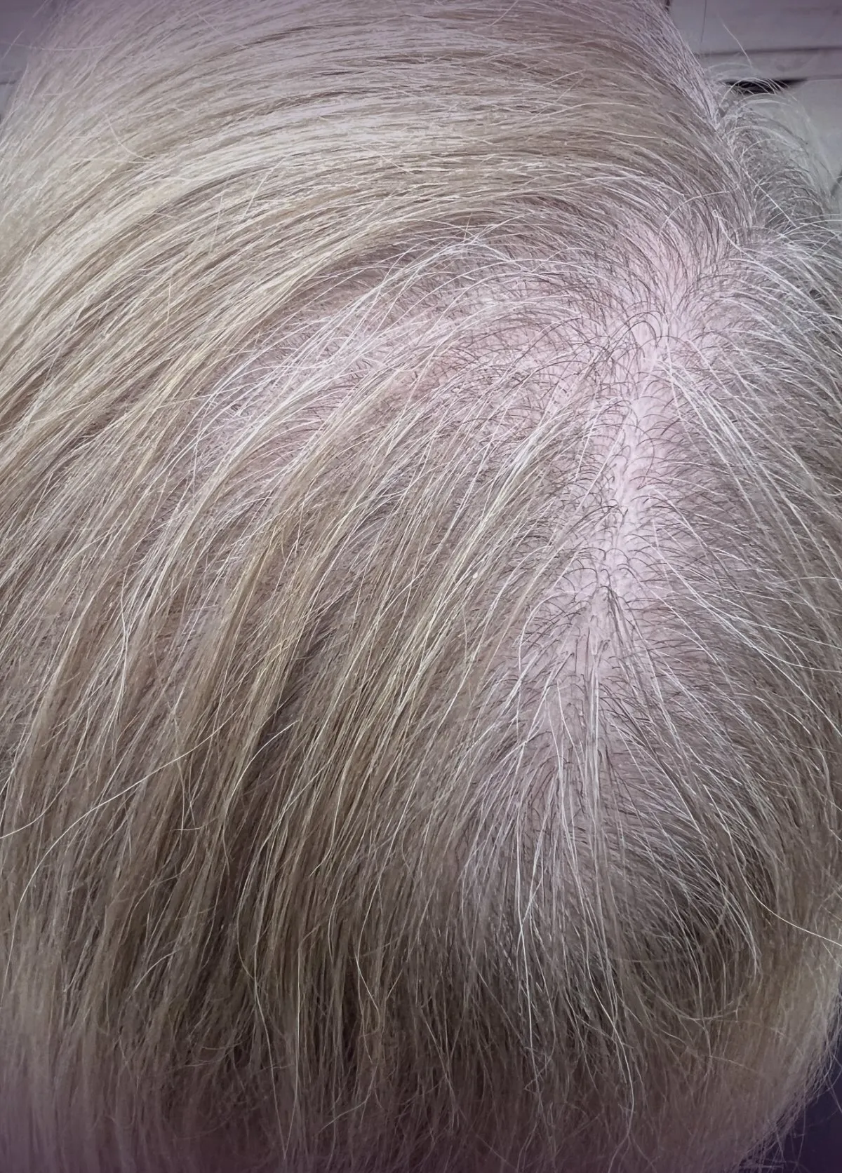 Before a custom hair topper fitting, showing thinning through the part and crown